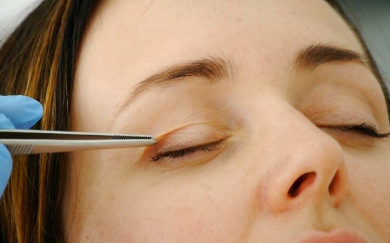 Cắt mí mắt là phương pháp được thực hiện nhanh và hiệu quả
